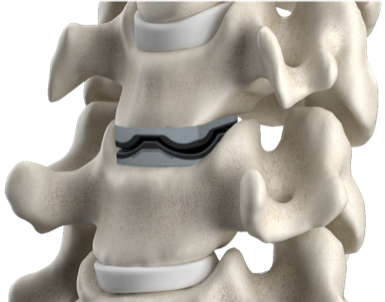 Triadyme-C Spine